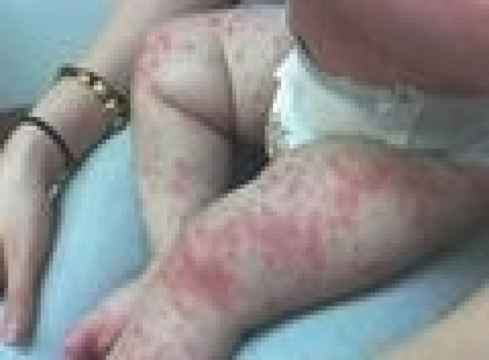 Медики рассказали, как уберечься от вируса Коксаки, массово поражающего украинских детей